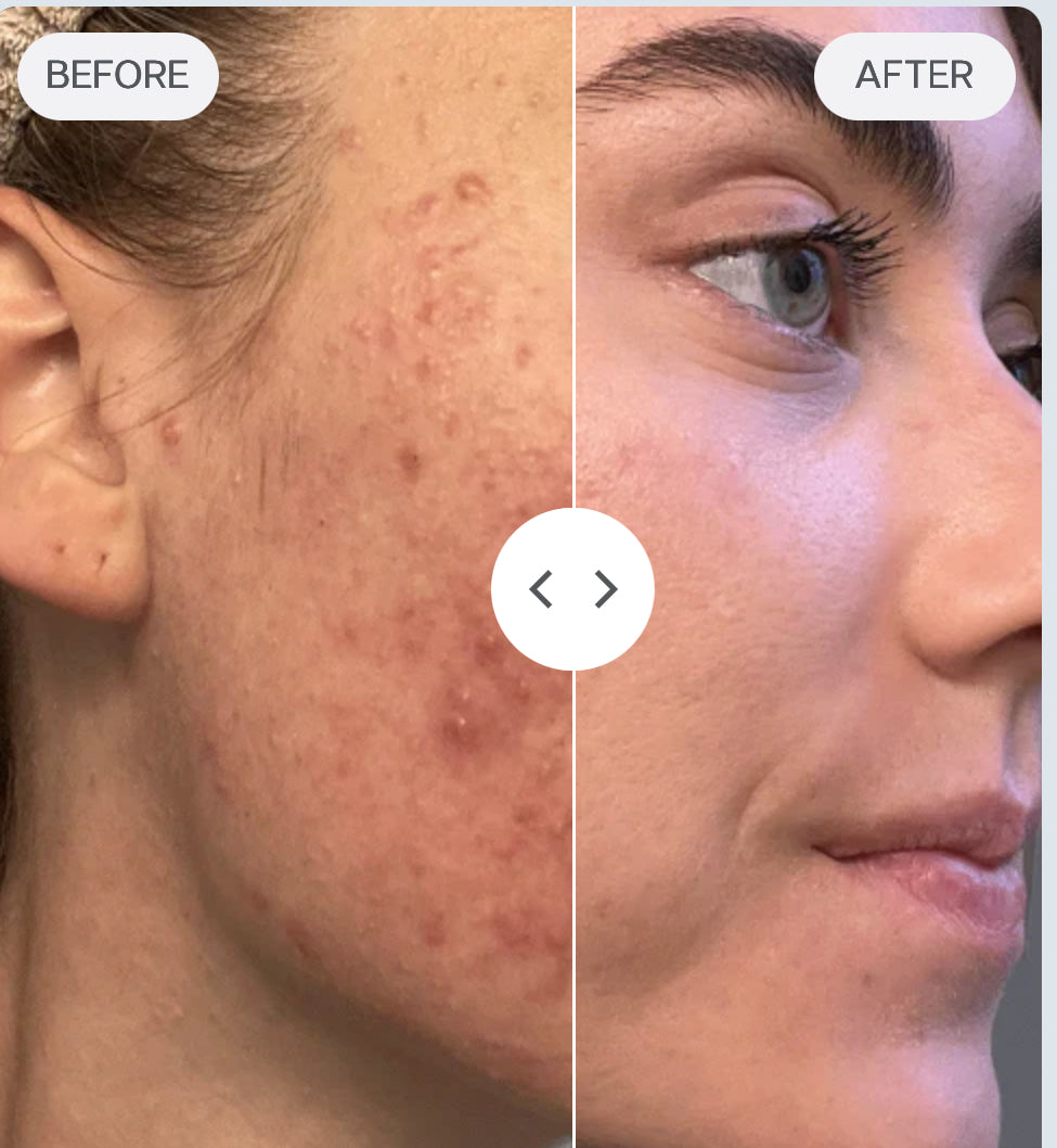 Acne Bootcamp Deposit